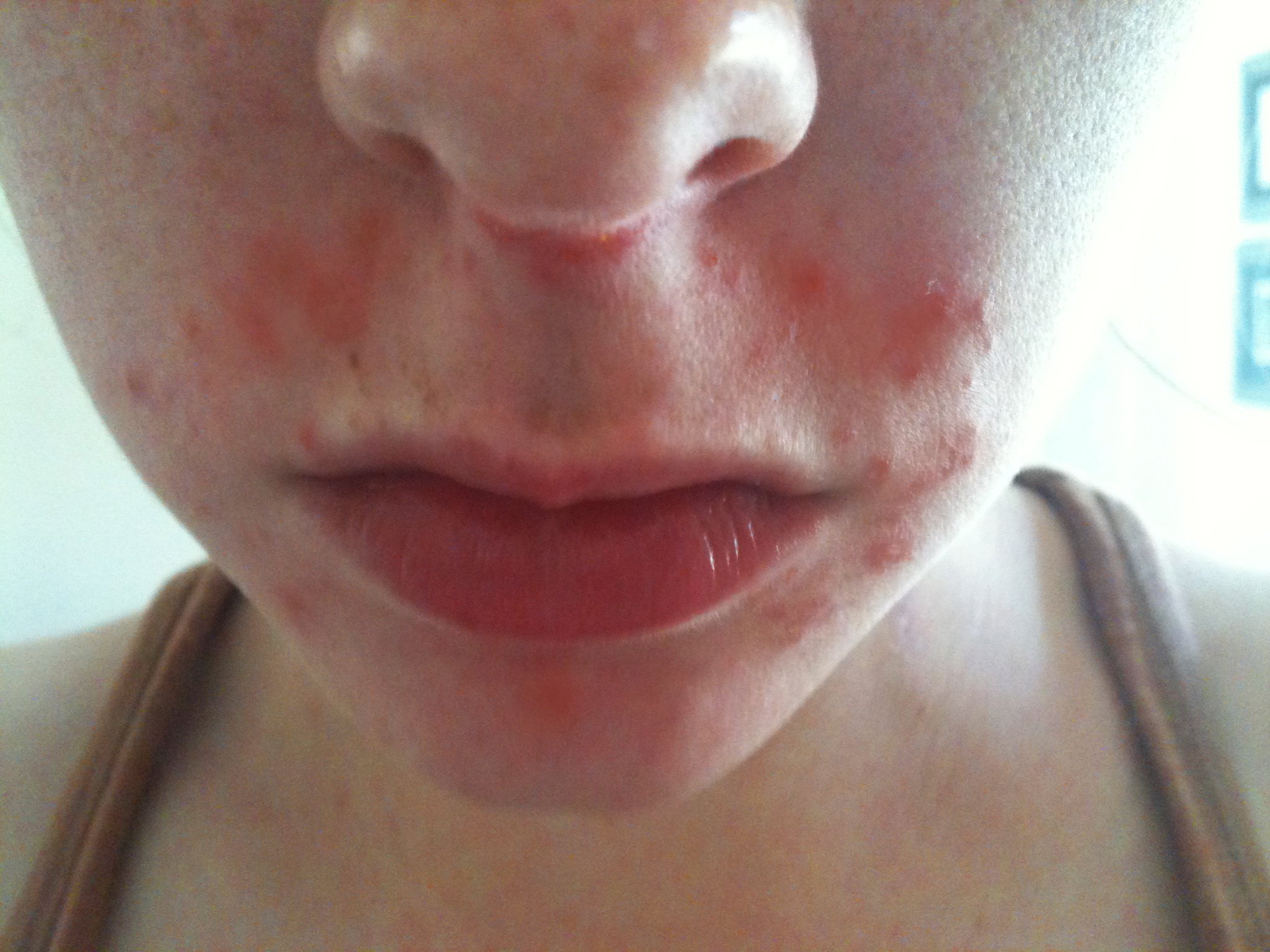 i have had persistent perioral dermatitis around my nose and