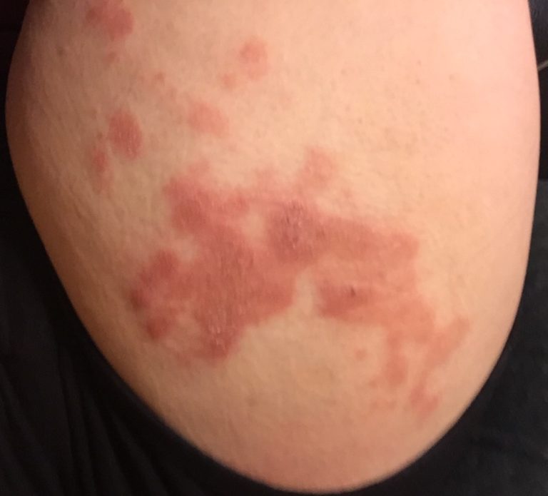 I have had this rash for about 2