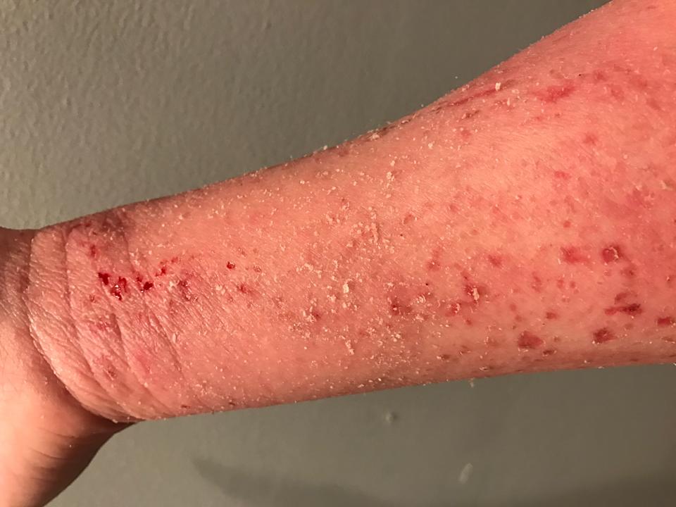 I Spent Six Years Learning How to Treat My Severe Eczema