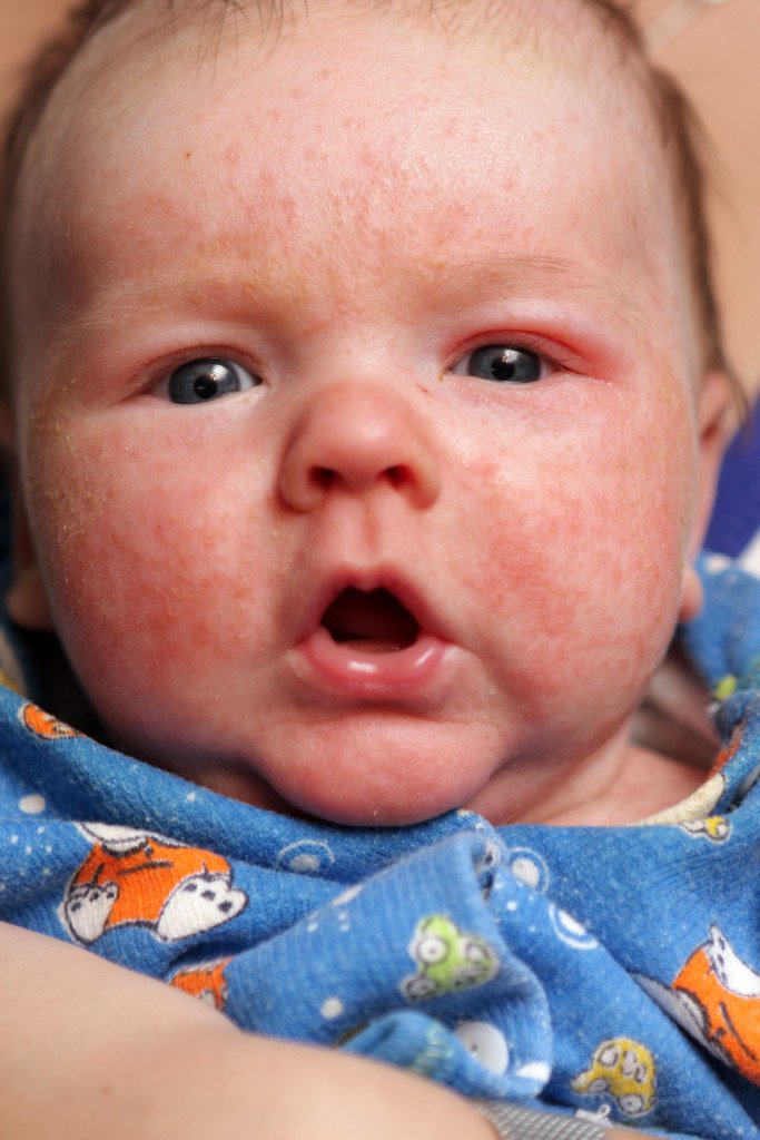 Identify Baby Eczema Symptoms
