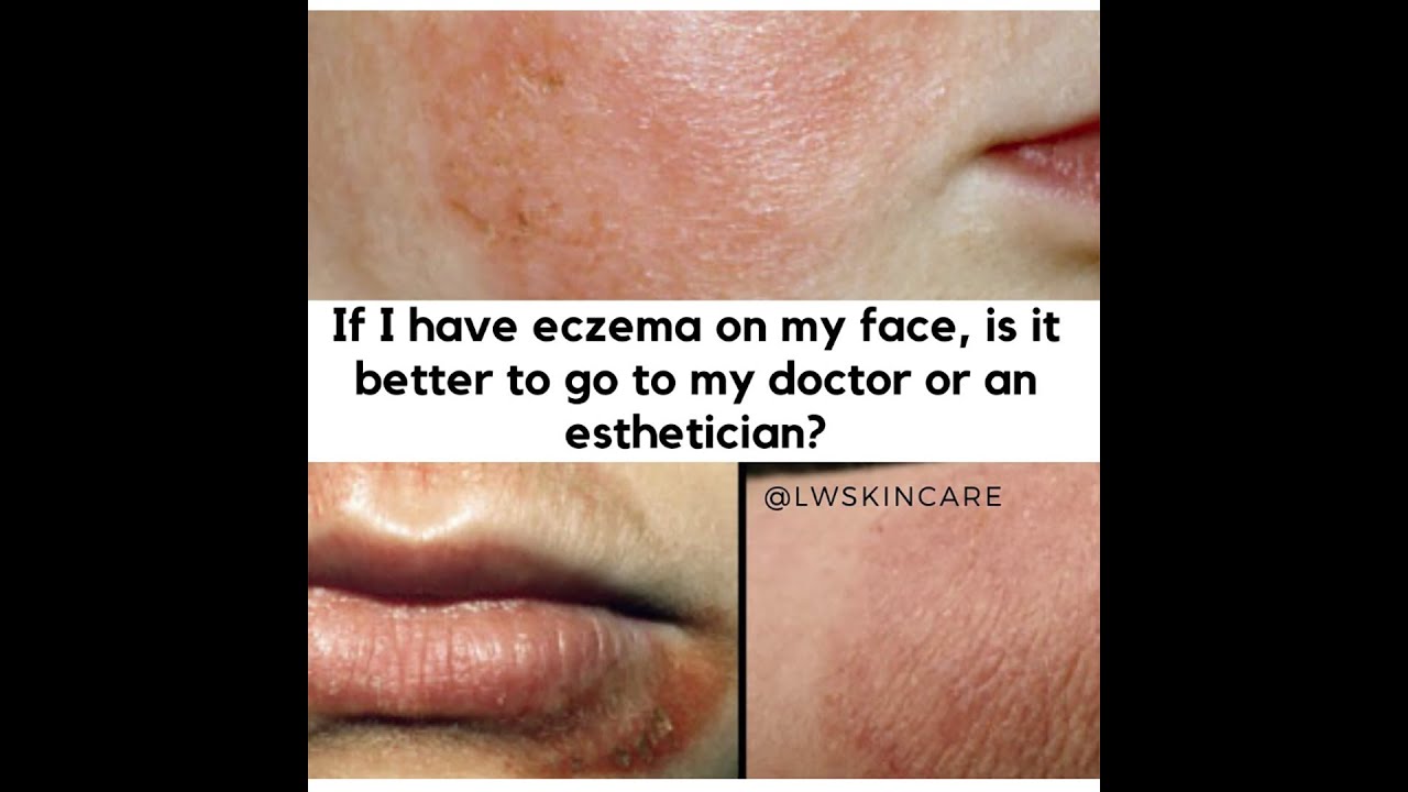 If I have eczema on my face, is it better to go to my ...