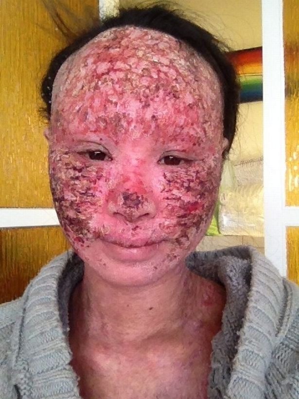 Incredible transformation of mum who overcame eczema so agonising it ...