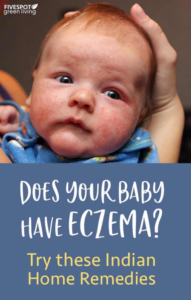 Indian Home Remedies for Eczema in Babies