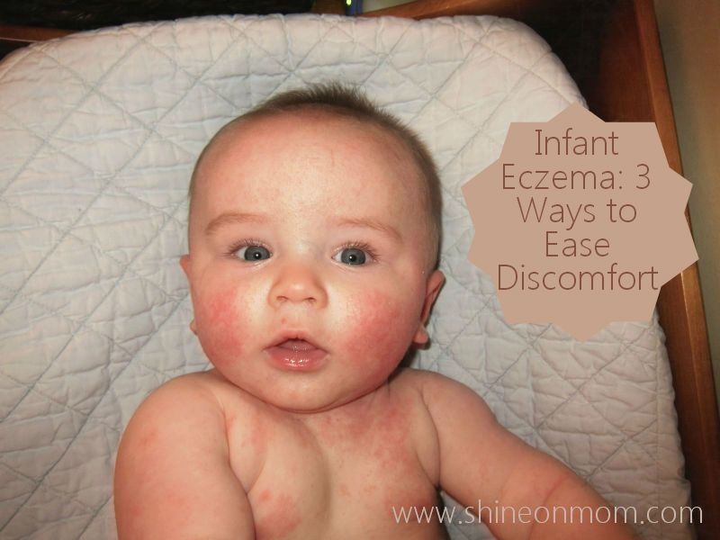Infant Eczema #EczemaRemedies