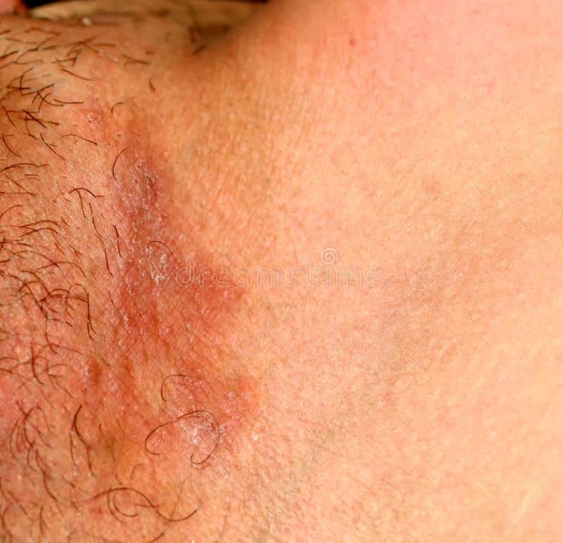 Infección Por Hongos En La Ingle, Psoriasis, Dermatitis, Eczema Foto de ...