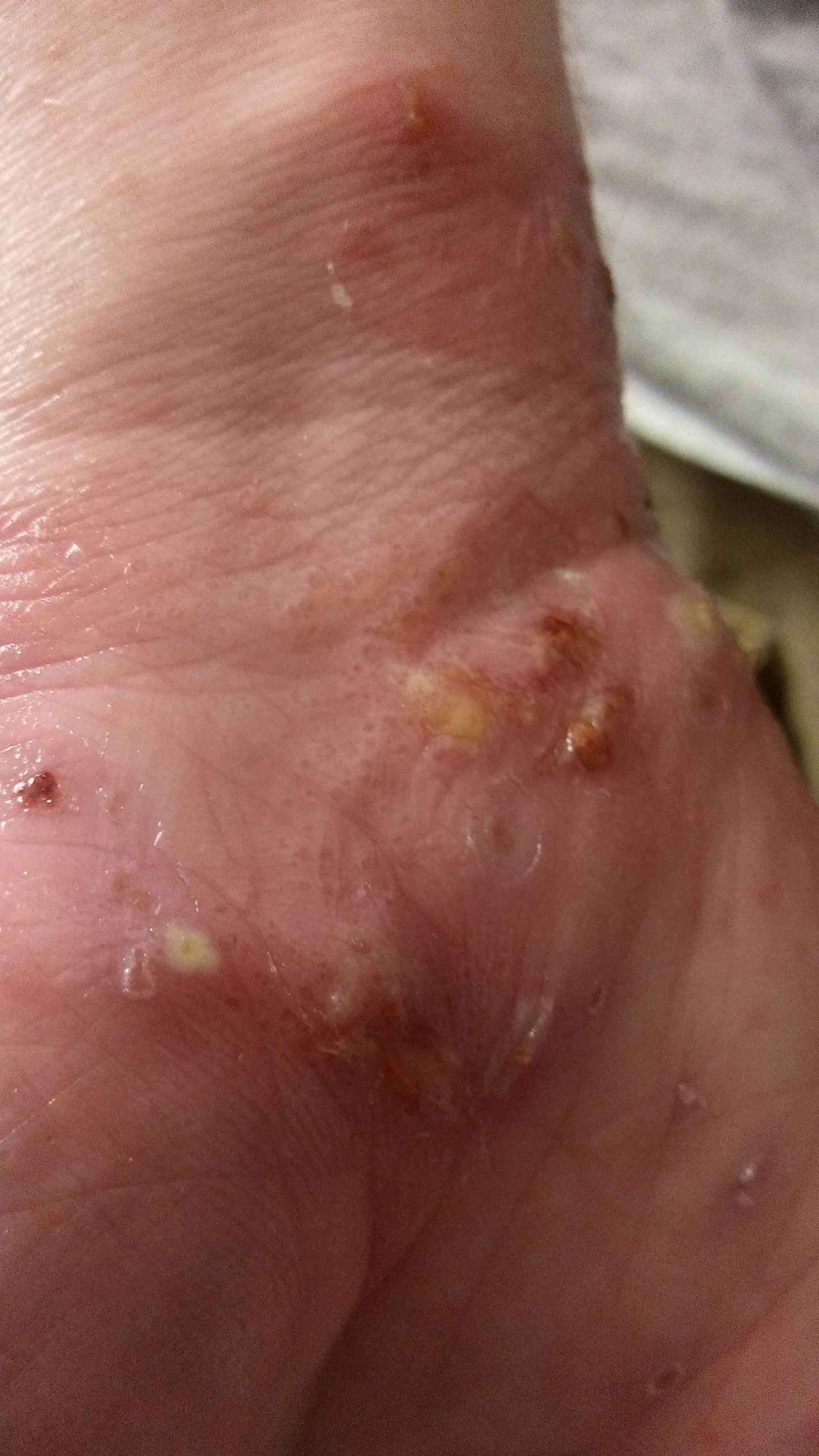 Infected dyshidrotic eczema : popping