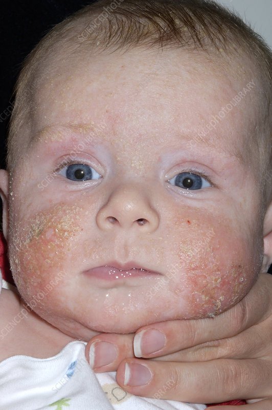 Infected eczema on a baby