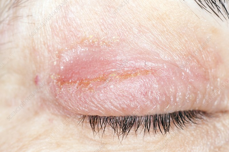 Infected eczema on the eyelid