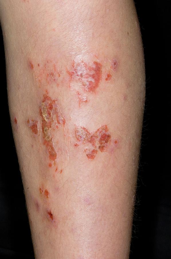Infected Eczema Photograph by Dr P. Marazzi/science Photo Library