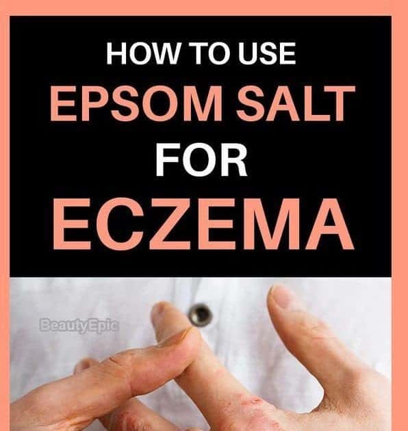 Is A Epsom Salt Bath Good For Eczema