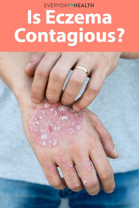 Is Eczema Contagious? 2 Skincare Experts Weigh In in 2020 ...