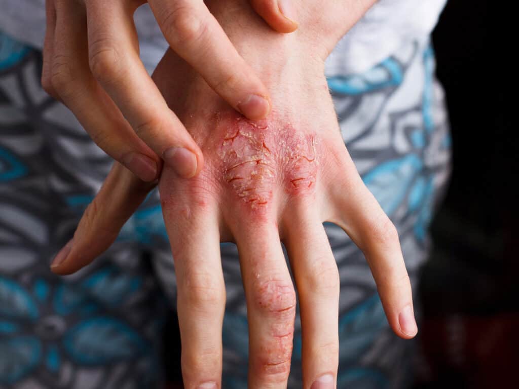 Is Eczema Contagious? Causes, Remedies, What to do at Home and ...