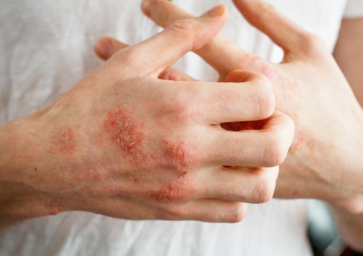 Is Homeopathic Clinic Good For Eczema