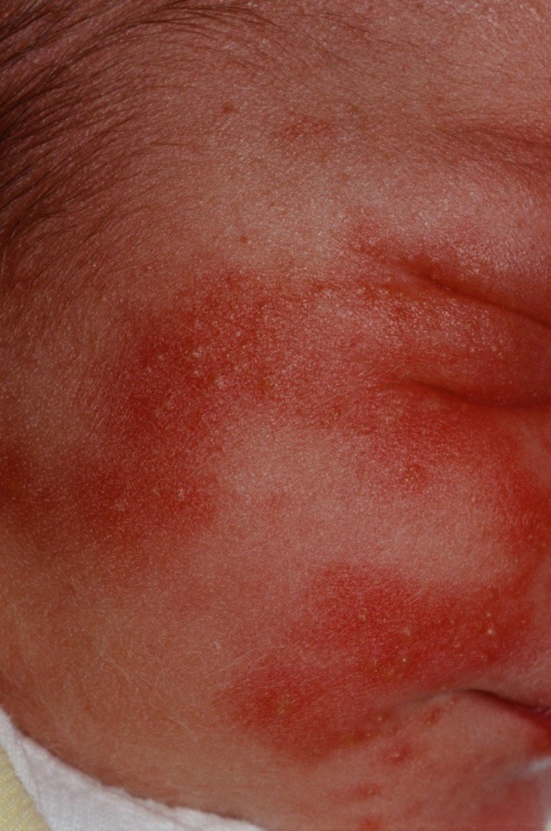 Is It a Rash or Baby Acne?