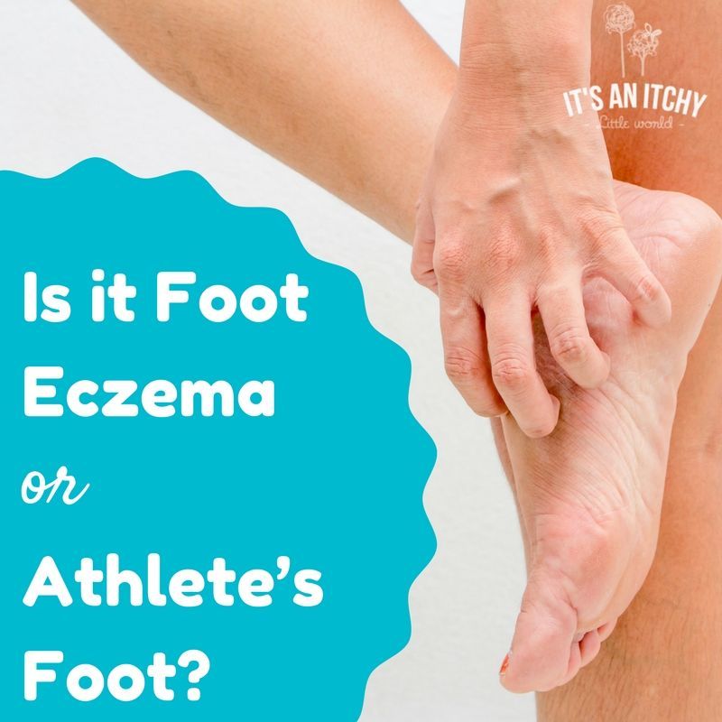 Is it Foot Eczema or Athleteâs Foot? #eczematypes