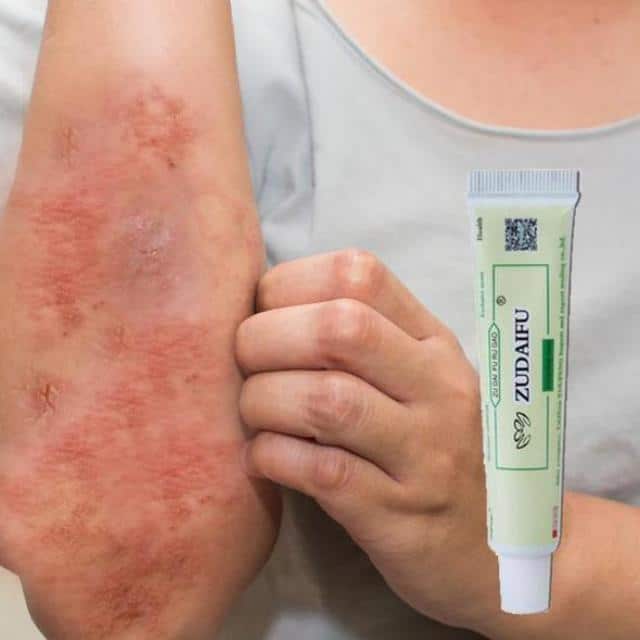Is It Possible To Have Eczema And Psoriasis