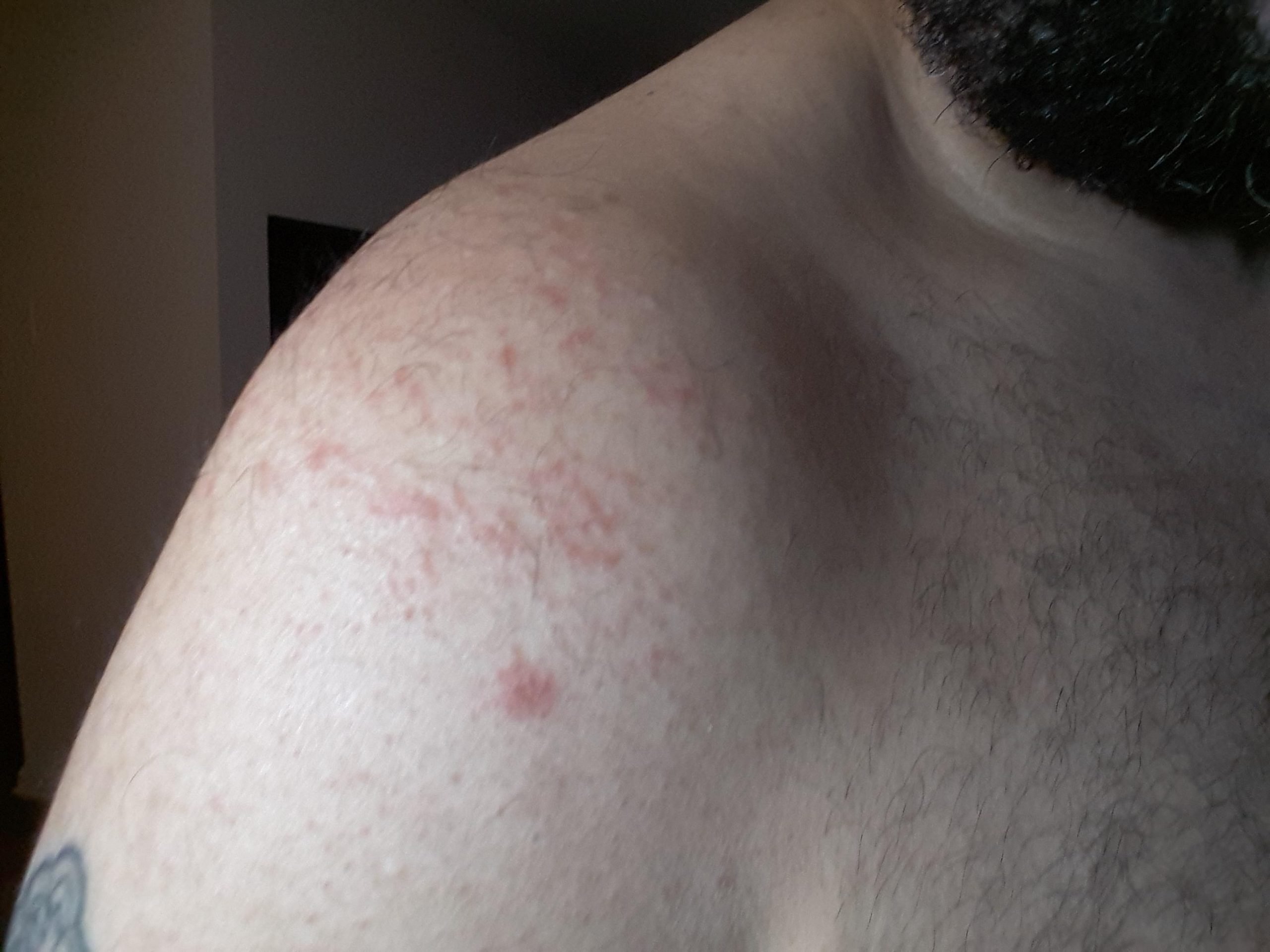 Is this eczema or some type of other rash? (Image) : Accutane