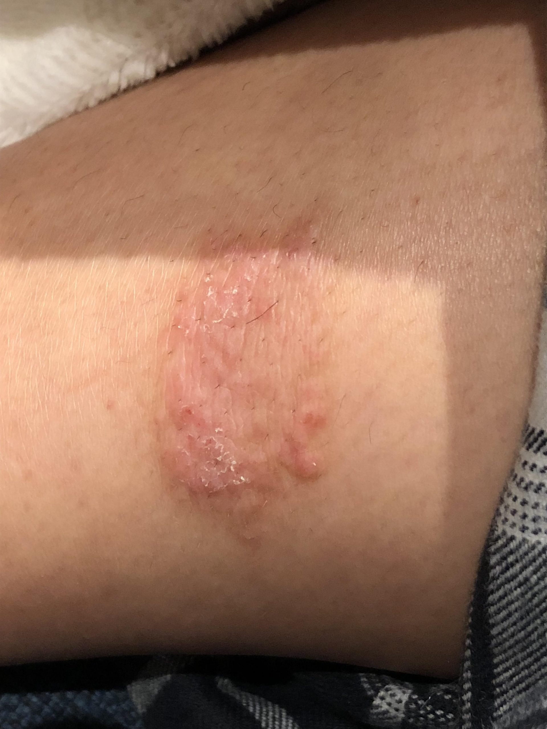 Is this nummular eczema or ringworm? Located on side of ...