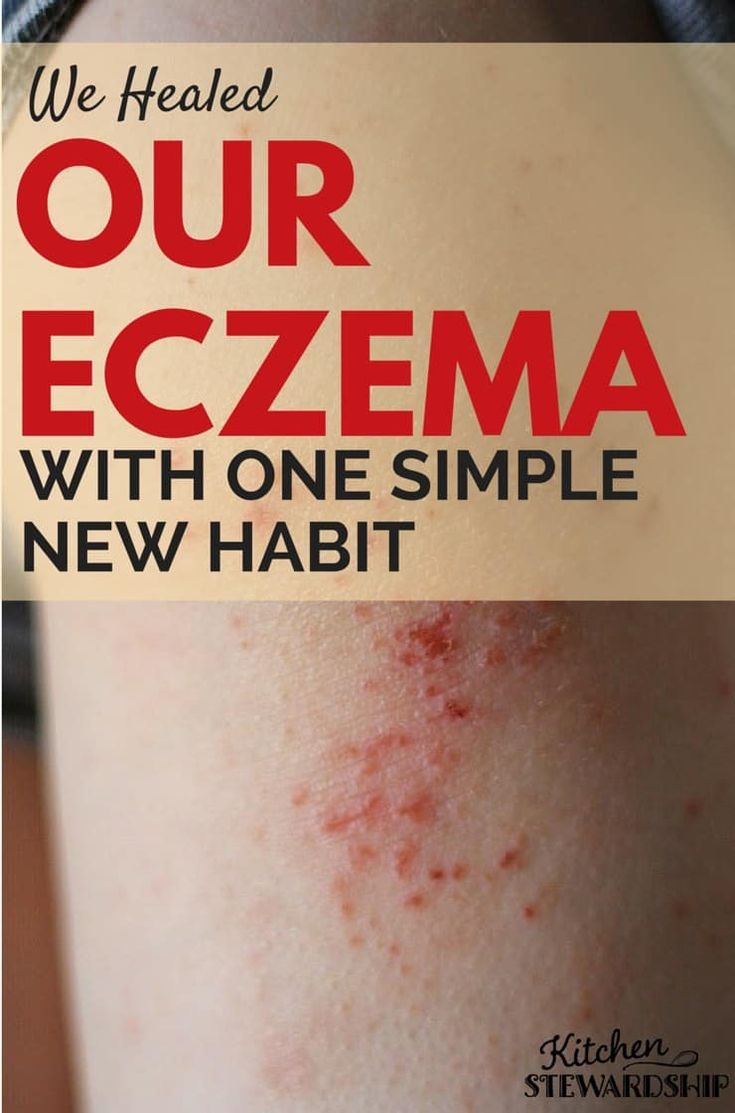 It is possible to heal your eczema naturally! I