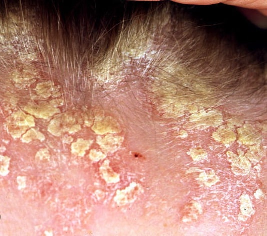 itchy sores on scalp