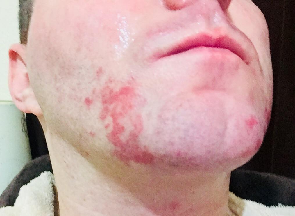 Ive had this rash for about 6 months on both sides of my chin. The ...