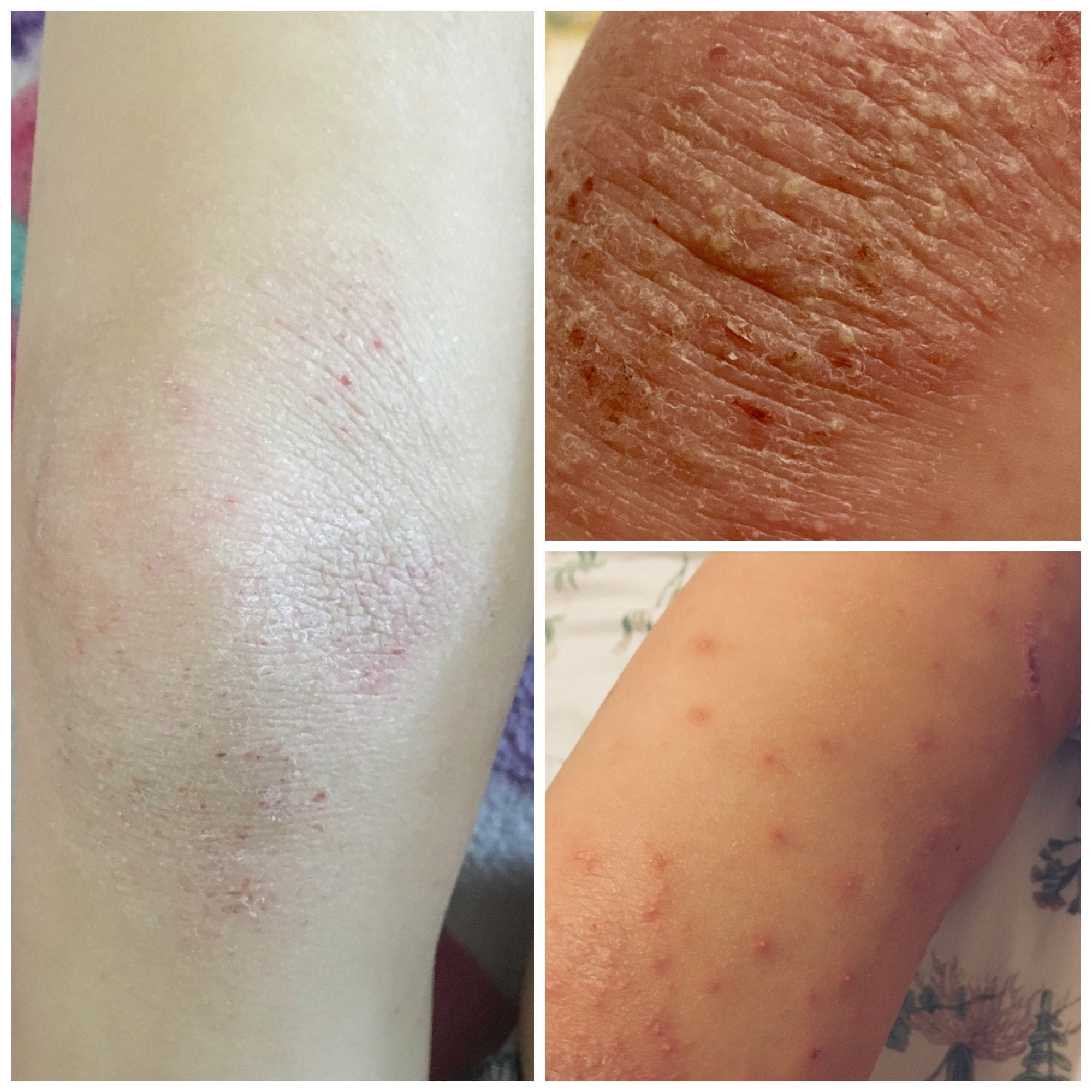 Ivy, Eczema, and a Bacterial Infection