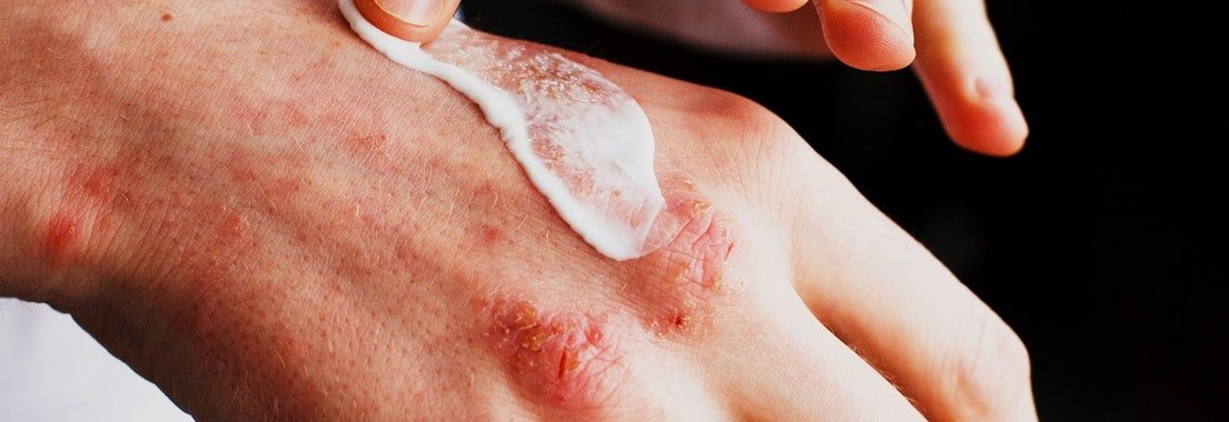 Keep Your Dermatitis/Eczema Under Control This Winter ...