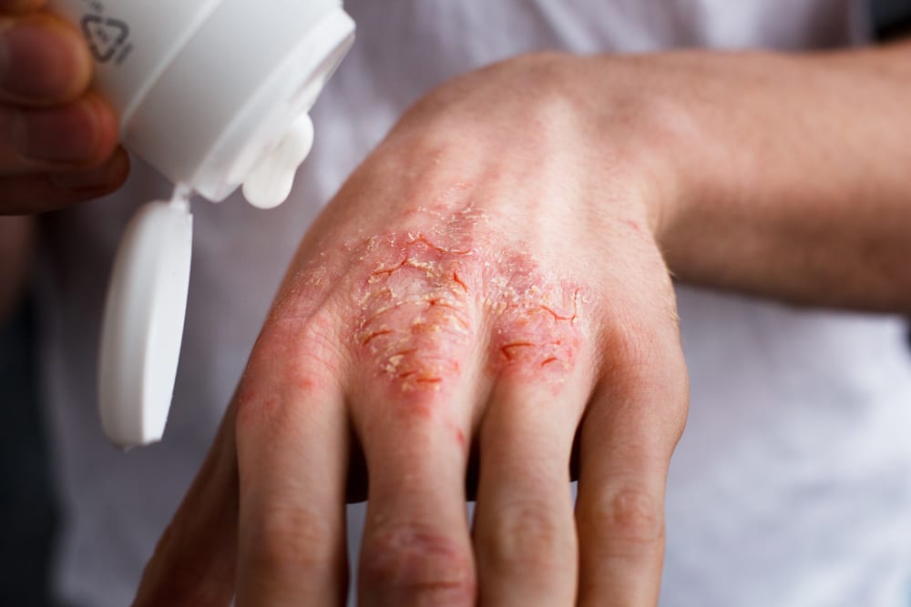 Keep Your Eczema Under Control With These Quick Tips