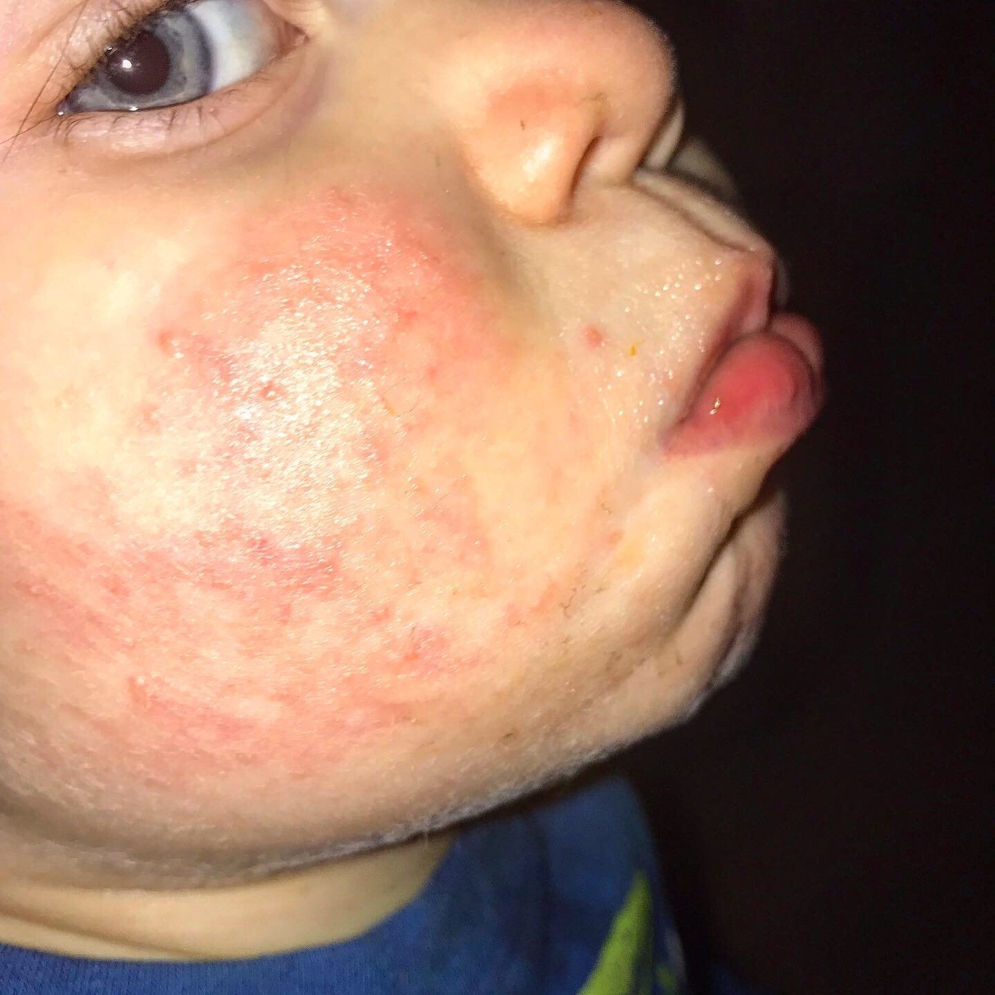 Keratosis pilaris? Eczema? : toddlers