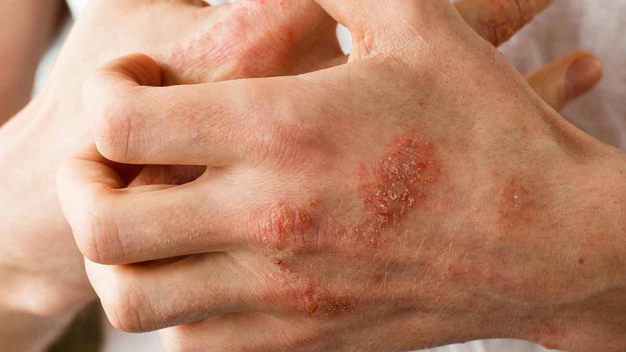 Know about Eczema &  Siddha Treatment