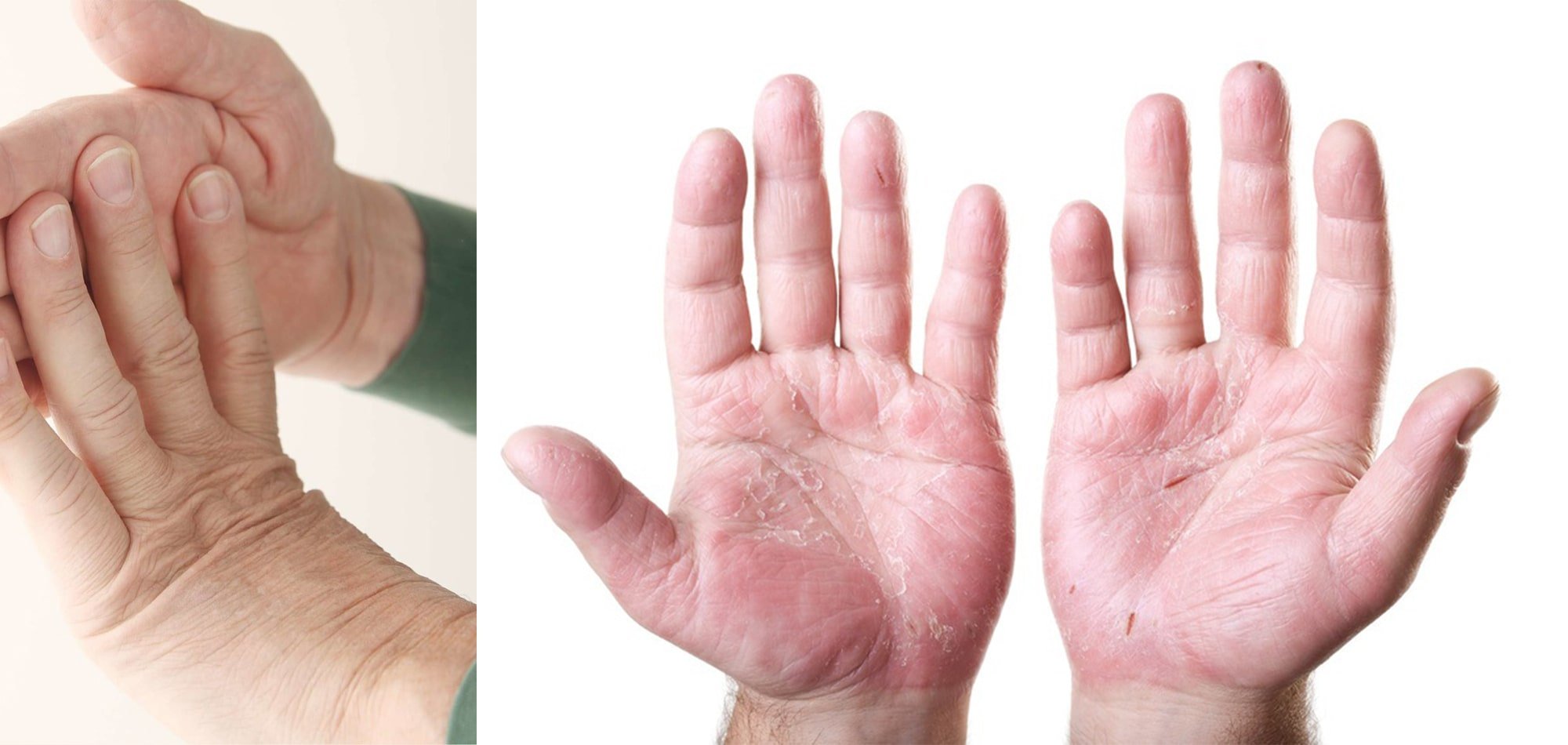 Know More About Psoriasis Disease, Eczema, Fungal ...