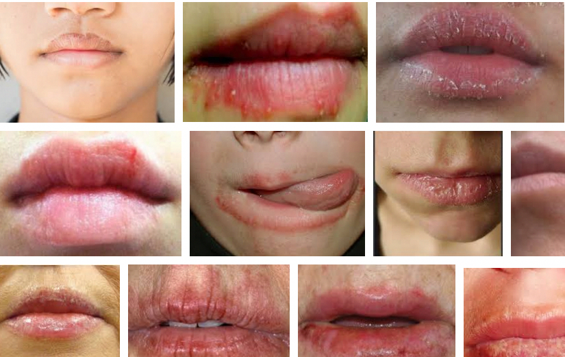 Lip dermatitis or Eczema on the lip is an inflammatory skin condition ...
