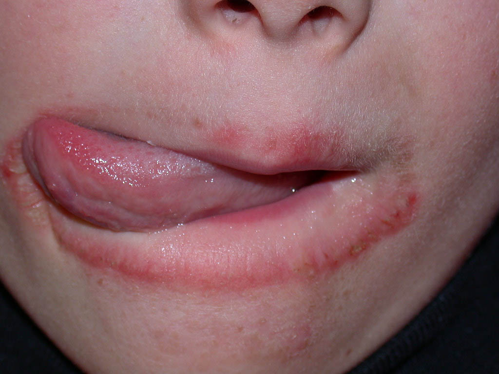 Lip Eczema Cause, Symptoms, on Baby, How to Treat, Cure, Home Remedies ...