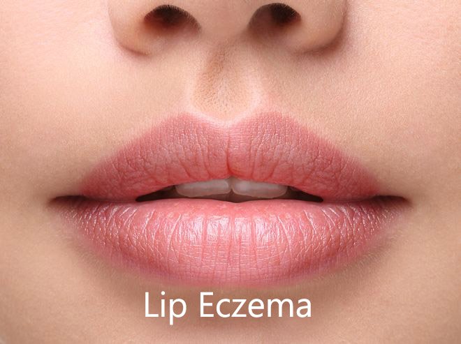 Lip Eczema, lip dermatitis: how to deal with it?