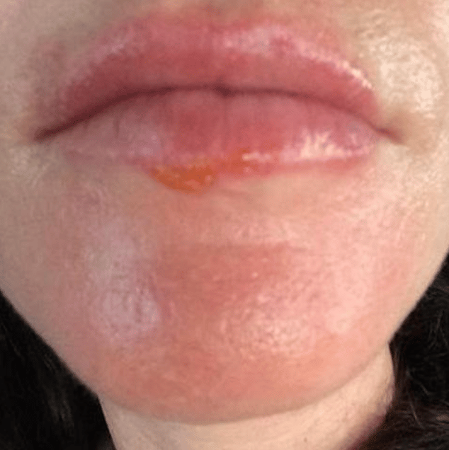 Lip Problems including Cheilitis &  Dermatitis  Osmia