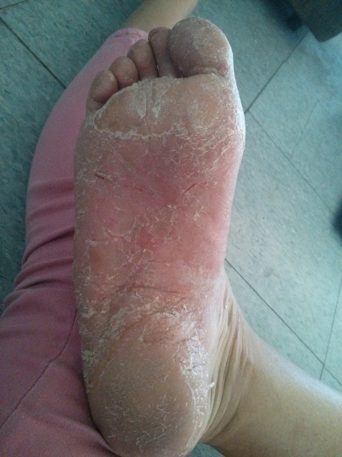 Living With Dyshidrosis/Pompholyx: Peeling badly, signs of third outbreak