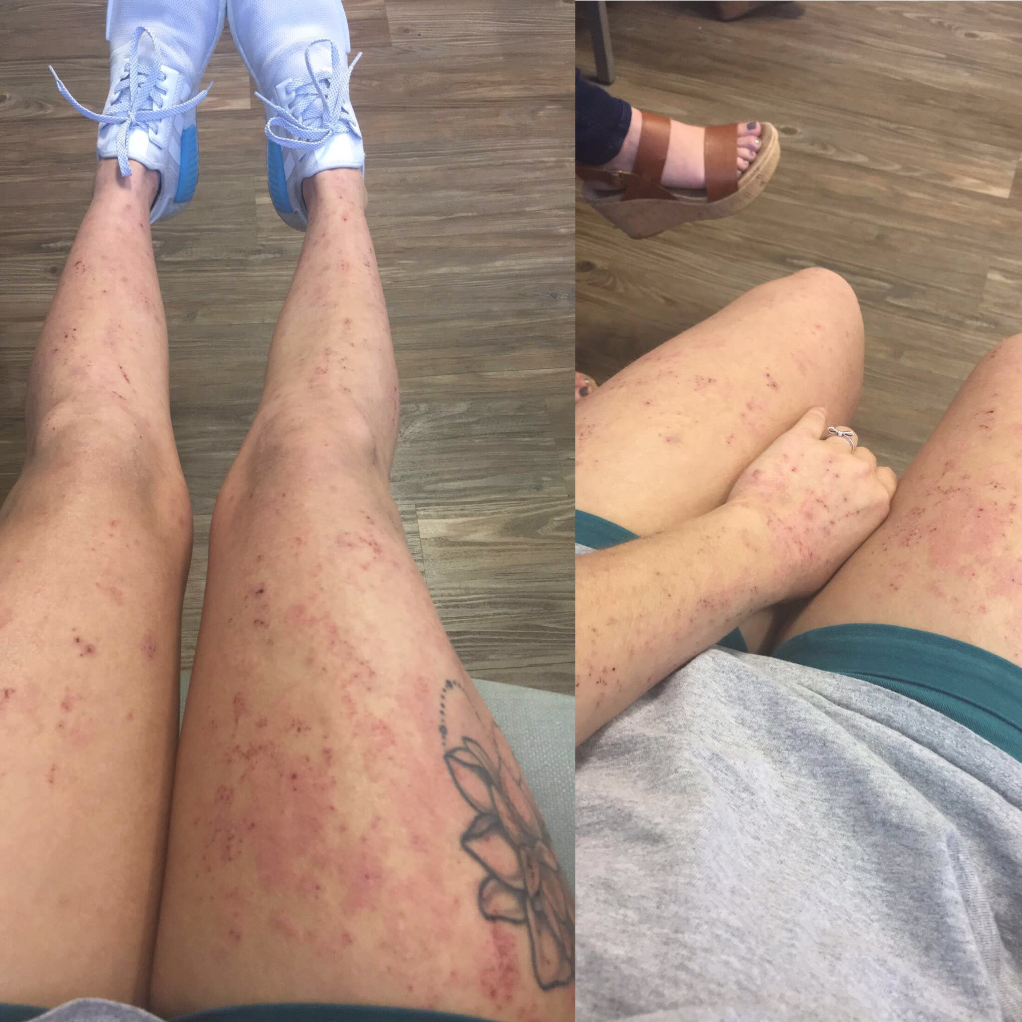 Living with Severe Eczema