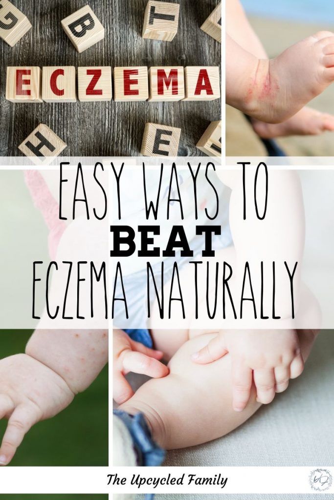 Looking for a natural solution to beat eczema?