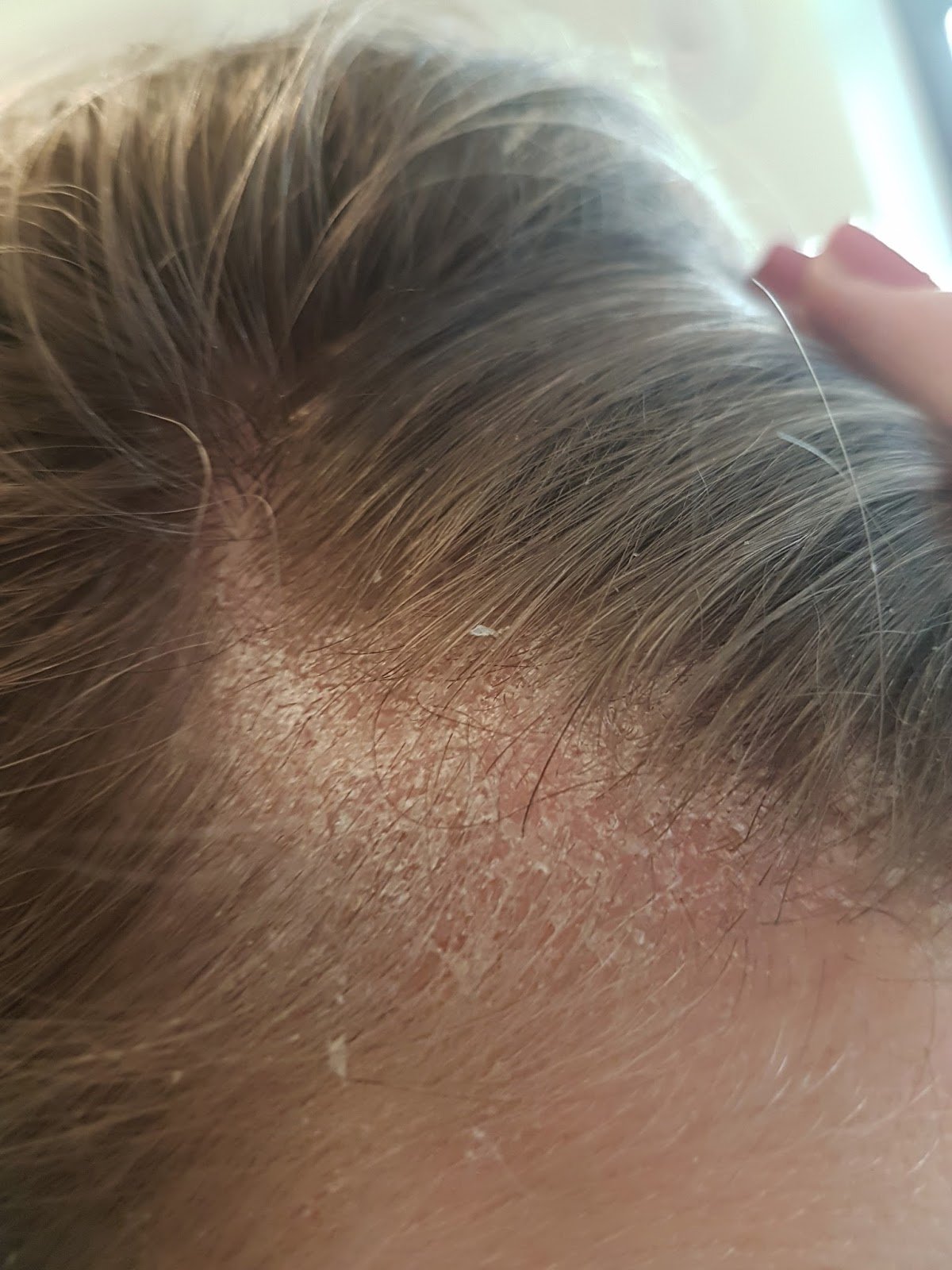 Lost in the Oyster: Scalp Eczema
