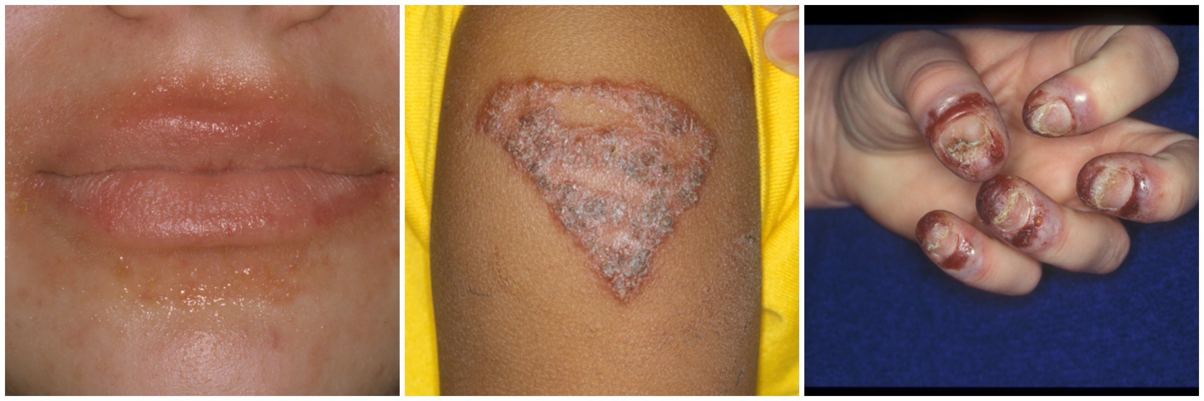 Many substances can cause eczema