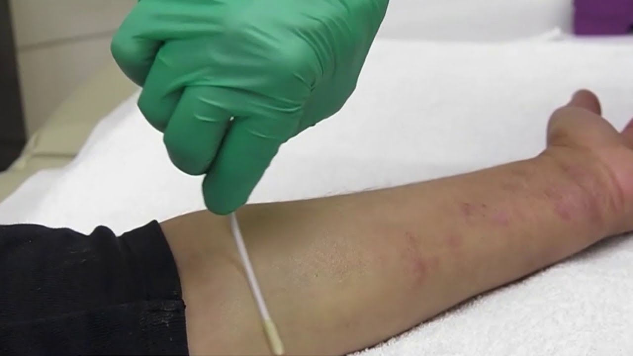 Medical experts test new eczema treatment