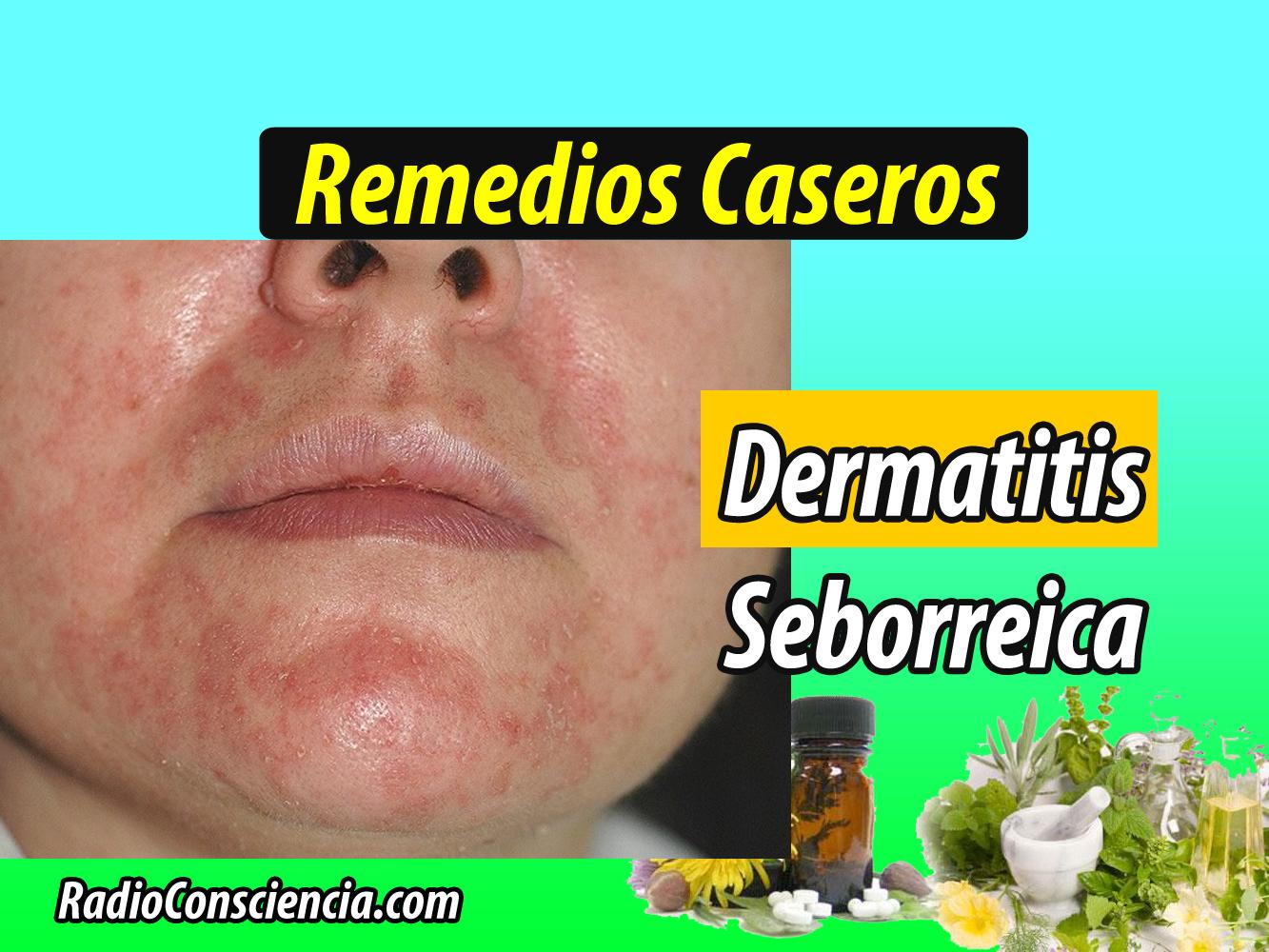 Medicina Casera: Remedio para la Dermatitis seborreica ...