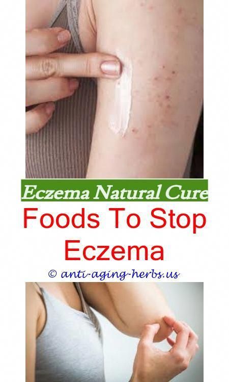 mild case of eczema how to get rid of severe eczema fast ...