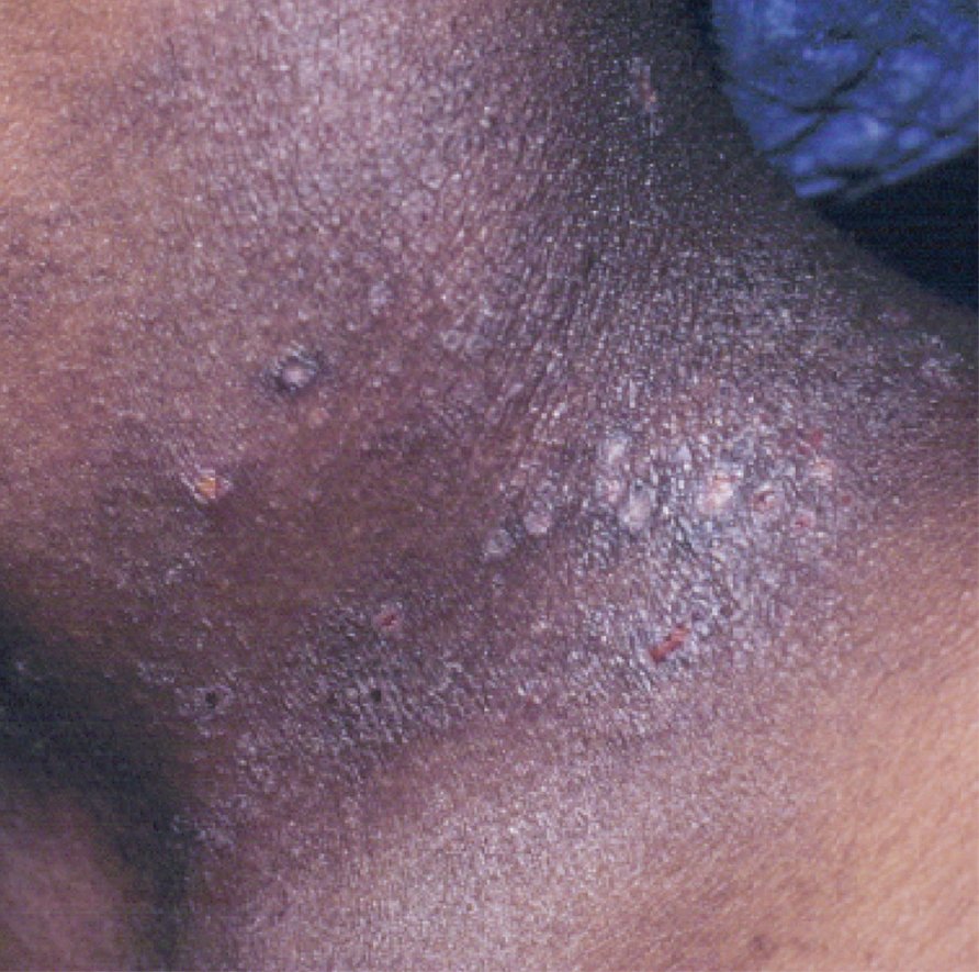 mimin: [29+] Eczema Mild Psoriasis On Black Skin