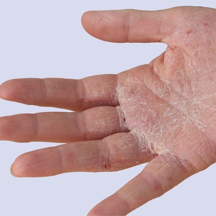 Mix · Dyshidrotic Eczema AKA Itchy Hands and Feet