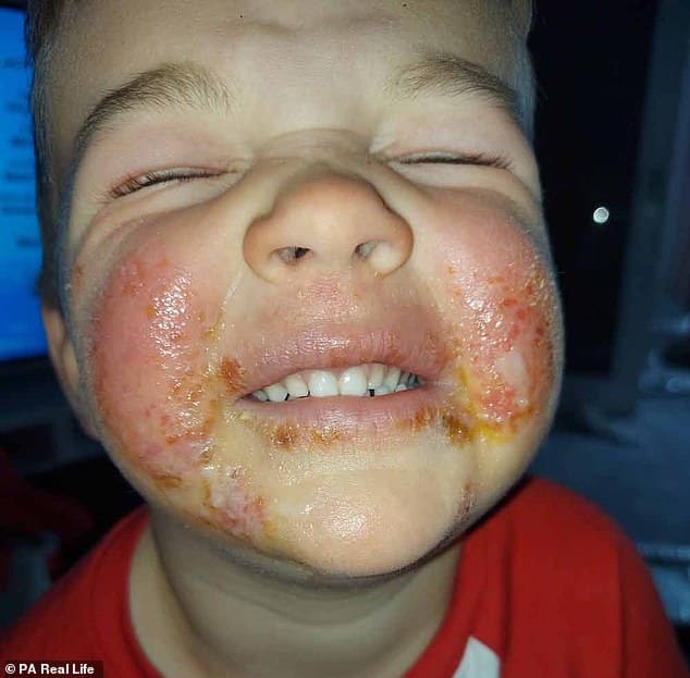 Mother of boy, 3, with painful facial blisters caused by eczema reveals ...