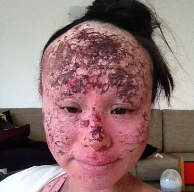 Mother who decided to stop steroid cream for facial eczema after it ...