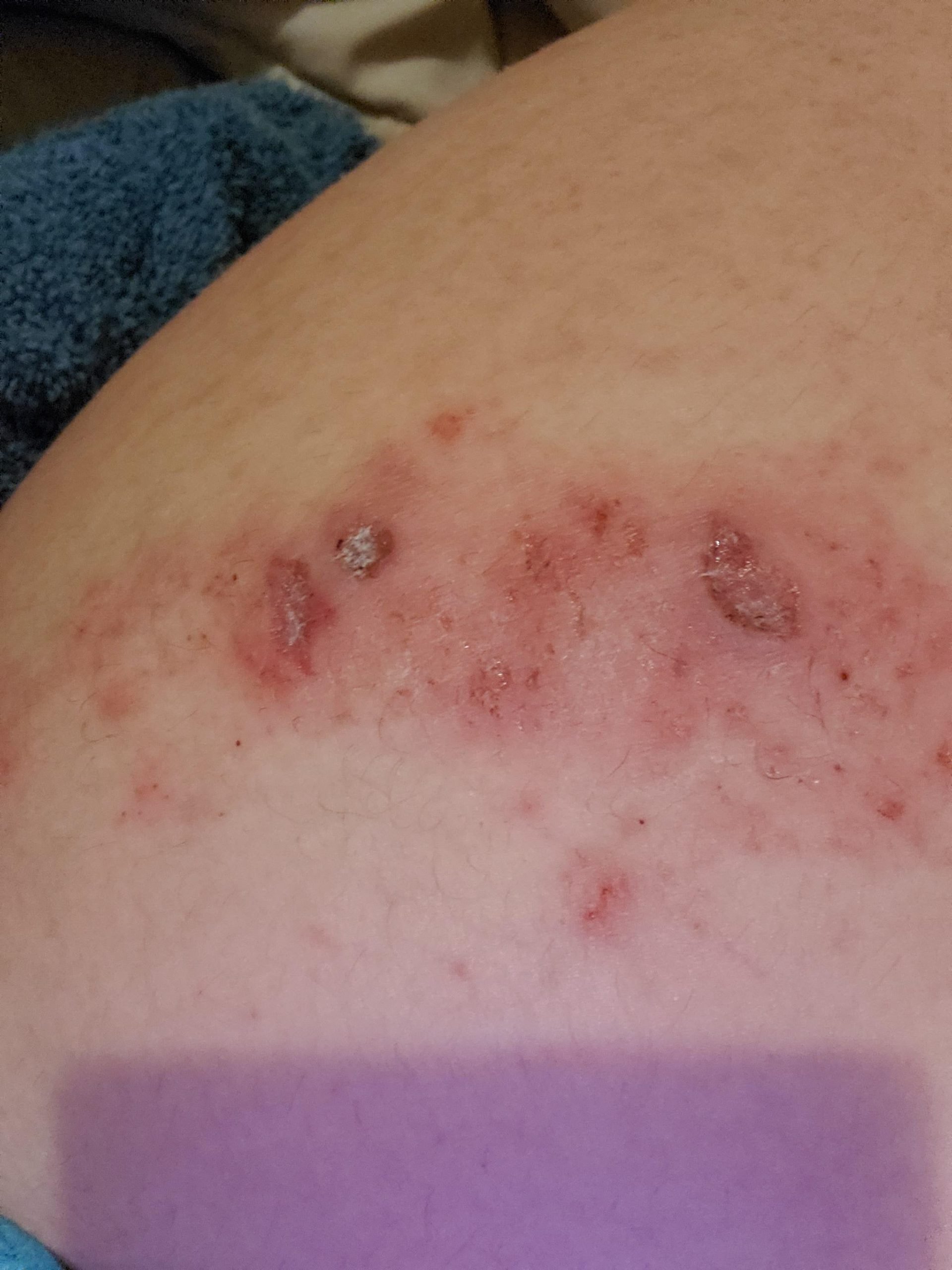 My (18 FtM) eczema is keeping me up at night ...