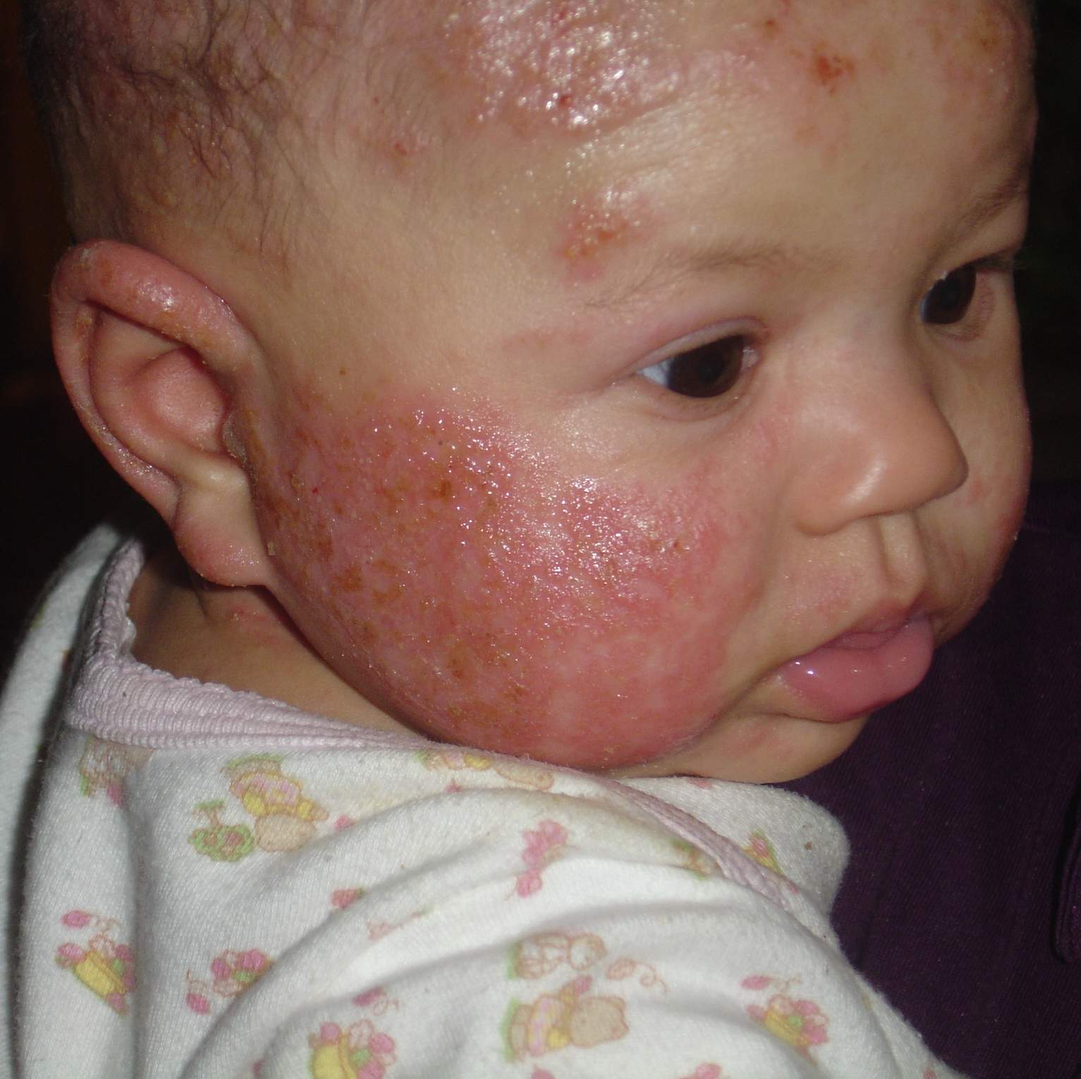 My Baby Has Eczema