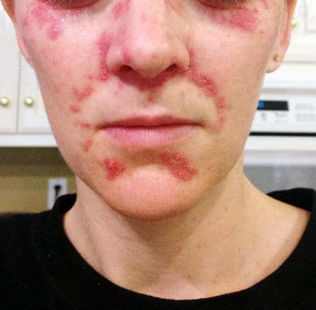 My Battle with Eczema, Perioral Dermatitis, and Corticosteroid Cream ...